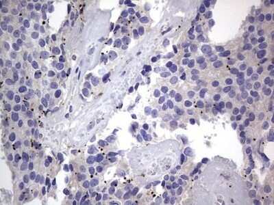 Immunohistochemistry: PRRX1 Antibody (OTI1E10) - Azide and BSA Free [NBP2-73678] - Analysis of Adenocarcinoma of Human breast tissue. (Heat-induced epitope retrieval by 1 mM EDTA in 10mM Tris, pH8.5, 120C for 3min)