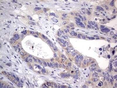 Immunohistochemistry: PRRX1 Antibody (OTI1E10) - Azide and BSA Free [NBP2-73678] - Analysis of Adenocarcinoma of Human colon tissue. (Heat-induced epitope retrieval by 1 mM EDTA in 10mM Tris, pH8.5, 120C for 3min)