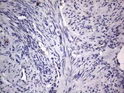 Immunohistochemistry: PRRX1 Antibody (OTI1E10) - Azide and BSA Free [NBP2-73678] - Analysis of Adenocarcinoma of Human endometrium tissue. (Heat-induced epitope retrieval by 1 mM EDTA in 10mM Tris, pH8.5, 120C for 3min)