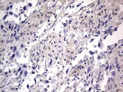 Immunohistochemistry: PRRX1 Antibody (OTI1E10) - Azide and BSA Free [NBP2-73678] - Analysis of Adenocarcinoma of Human ovary tissue. (Heat-induced epitope retrieval by 1 mM EDTA in 10mM Tris, pH8.5, 120C for 3min)