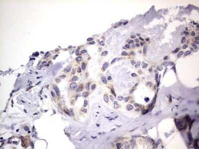 Immunohistochemistry: PRRX1 Antibody (OTI1E10) - Azide and BSA Free [NBP2-73678] - Analysis of Carcinoma of Human liver tissue.(Heat-induced epitope retrieval by 1 mM EDTA in 10mM Tris, pH8.5, 120C for 3min)