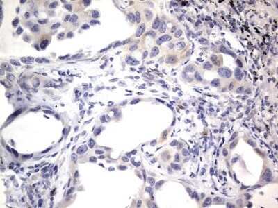 Immunohistochemistry: PRRX1 Antibody (OTI1E10) - Azide and BSA Free [NBP2-73678] - Analysis of Carcinoma of Human lung tissue.(Heat-induced epitope retrieval by 1 mM EDTA in 10mM Tris, pH8.5, 120C for 3min)