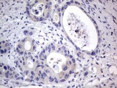 Immunohistochemistry: PRRX1 Antibody (OTI1E10) - Azide and BSA Free [NBP2-73678] - Analysis of Carcinoma of Human pancreas tissue. (Heat-induced epitope retrieval by 1 mM EDTA in 10mM Tris, pH8.5, 120C for 3min)