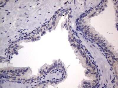 Immunohistochemistry: PRRX1 Antibody (OTI1E10) - Azide and BSA Free [NBP2-73678] - Analysis of Carcinoma of Human prostate tissue. (Heat-induced epitope retrieval by 1 mM EDTA in 10mM Tris, pH8.5, 120C for 3min)