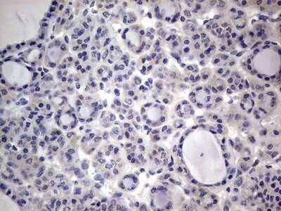 Immunohistochemistry: PRRX1 Antibody (OTI1E10) - Azide and BSA Free [NBP2-73678] - Analysis of Carcinoma of Human thyroid tissue. (Heat-induced epitope retrieval by 1 mM EDTA in 10mM Tris, pH8.5, 120C for 3min)