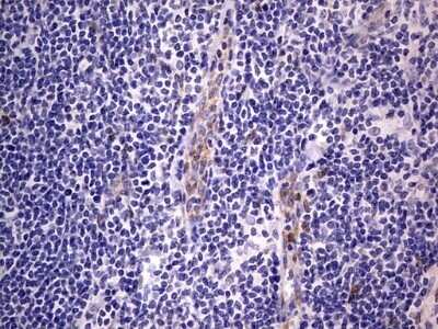 Immunohistochemistry: PRRX1 Antibody (OTI1E10) - Azide and BSA Free [NBP2-73678] - Analysis of Human lymphoma tissue. (Heat-induced epitope retrieval by 1 mM EDTA in 10mM Tris, pH8.5, 120C for 3min)