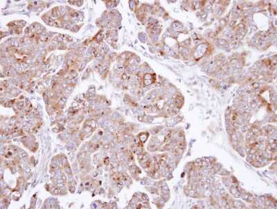 Immunohistochemistry-Paraffin: PSAP Antibody [NBP1-33459] - Paraffin-embedded NCIN87 xenograft, using antibody at 1:500 dilution.