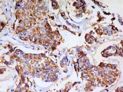 Immunohistochemistry: PSGL-1/CD162 Antibody (HECA-452) - Azide and BSA Free [NBP2-80921] - IHC analysis of formalin-fixed paraffin-embedded tissue section of human breast adenocarcinoma using CLA antibody (clone HECA-452) at 5 ug/ml concentration. The antibody generated a membrane-cytoplasmic staining in the cancerous cells of breast adenocarci