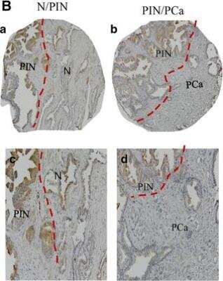 Immunohistochemistry: PSGR Antibody [NLS6332] - Expression of PSGR protein in normal prostate (N), prostatic intraepithelial neoplasia (PIN) and prostate cancer (PCa) by immunohistochemistry. Low (a and b) and high (c and d) magnification images of PSGR in N and adjacent PIN (a, c), and PIN and adjacent PCa (b, d) (original magnification x 10 and x 20 for low and high respectively). Image collected and cropped by CiteAb from the following publication (bmccancer.biomedcentral.com/articles/10.1186/s12885-015-1921-6), licensed under a CC-BY license.