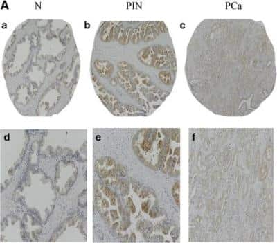Immunohistochemistry: PSGR Antibody [NLS6332] - Expression of PSGR protein in normal prostate (N), prostatic intraepithelial neoplasia (PIN) and prostate cancer (PCa) by immunohistochemistry. Low (a and b) and high (c and d) magnification images of PSGR in N and adjacent PIN (a, c), and PIN and adjacent PCa (b, d) (original magnification x 10 and x 20 for low and high respectively). Image collected and cropped by CiteAb from the following publication (bmccancer.biomedcentral.com/articles/10.1186/s12885-015-1921-6), licensed under a CC-BY license.