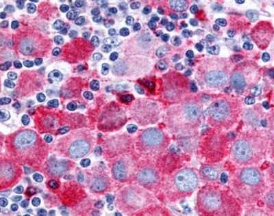 Immunohistochemistry-Paraffin: PSGR Antibody [NLS2027] - Analysis of anti-OR51E2 / PSGR antibody with human skin, melanoma.