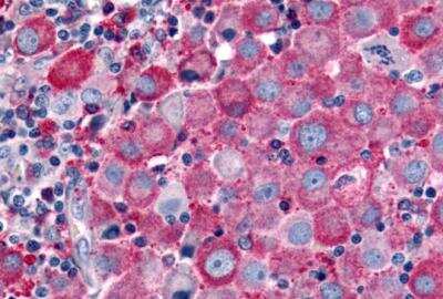 Immunohistochemistry-Paraffin: PSGR Antibody [NLS2027] - Skin, Malignant Melanoma