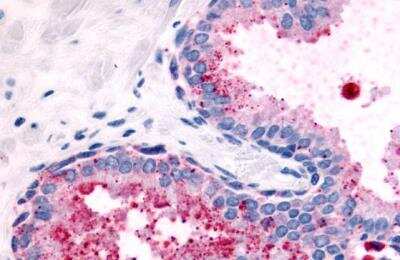 Immunohistochemistry-Paraffin: PSGR Antibody [NLS2027] - Prostate, Carcinoma