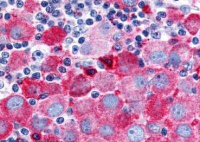 Immunohistochemistry-Paraffin: PSGR Antibody [NLS6332] - Human Skin, Melanoma tissue after heat-induced antigen retrieval.