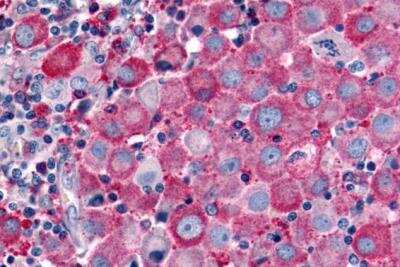 Immunohistochemistry-Paraffin: PSGR Antibody [NLS6332] - Skin, Malignant Melanoma