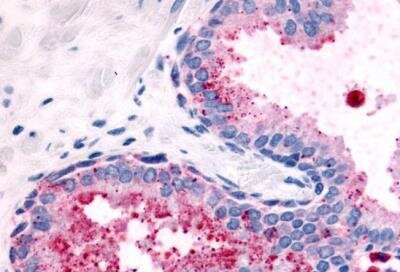 Immunohistochemistry-Paraffin: PSGR Antibody [NLS6332] - Prostate carcinoma