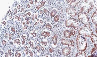 Immunohistochemistry-Paraffin: PSKH2 Antibody [NBP1-31467] - Paraffin-embedded gastric CA, using antibody at 1:100 dilution.