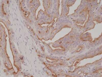 Immunohistochemistry: PSMA/FOLH1/NAALADase I Antibody (RM327) [NBP2-77411] - Immunohistochemical staining of formalin fixed and paraffin embedded human prostate cancer tissue section using NBP2-77411.