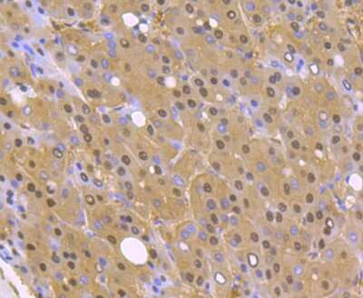 Immunohistochemistry-Paraffin: PSMA1 Antibody (JU66-24) [NBP2-75633] - Analysis of paraffin-embedded human liver cancer tissue using anti-PSMA1 antibody. Counter stained with hematoxylin.