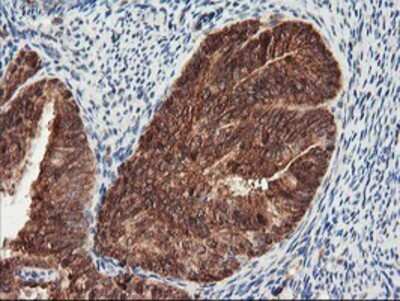 Immunohistochemistry: PSMA4 Antibody (OTI4B8) - Azide and BSA Free [NBP2-73690] - Staining of paraffin-embedded Adenocarcinoma of Human endometrium tissue using anti-PSMA4 mouse monoclonal antibody.