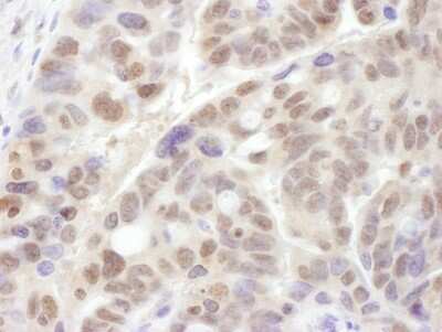 Immunohistochemistry-Paraffin: PSMC1 Antibody [NBP2-14857] - Sample: FFPE section of human ovarian carcinoma. Antibody: Affinity purified rabbit anti- PSMC1 used at a dilution of 1:1,000 (1ug/ml). Detection: DAB