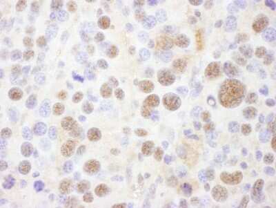 Immunohistochemistry-Paraffin: PSMC1 Antibody [NBP2-14857] - Sample: FFPE section of mouse renal cell carcinoma. Antibody: Affinity purified rabbit anti- PSMC1 used at a dilution of 1:1,000 (1ug/ml). Detection: DAB