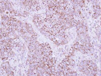 Immunohistochemistry-Paraffin: PSMD12 Antibody [NBP2-19986] - Immunohistochemical analysis of paraffin-embedded Breast ca, using antibody at 1:500 dilution.