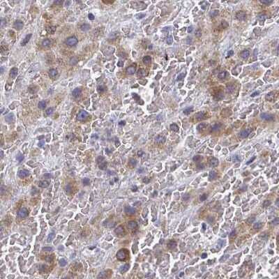 Immunohistochemistry: PSMG1 Antibody [NBP2-33820] - Staining of liver cancer.