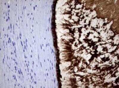 Immunohistochemistry: PSP94/MSMB Antibody (OTI3D5) - Azide and BSA Free [NBP2-73625] - Analysis of Carcinoma of Human prostate tissue.