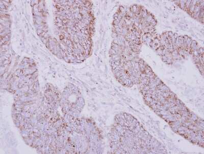 <b>Genetic Strategies Validation. </b>Immunohistochemistry-Paraffin: PSTPIP2 Antibody [NBP2-19995] - Immunohistochemical analysis of paraffin-embedded Colon ca, using antibody at 1:250 dilution.