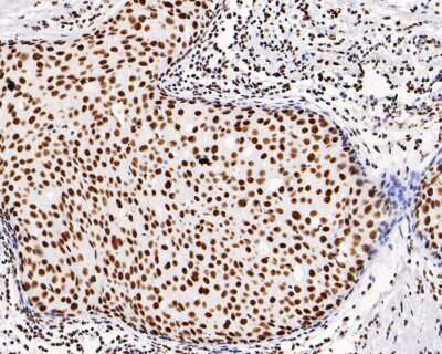 Immunohistochemistry-Paraffin: PTBP1 Antibody (5C1) [NBP2-75635] - Analysis of paraffin-embedded human breast cancer tissue with Mouse anti-PTBP1 antibody at 1/2000 dilution. The section was pre-treated using heat mediated antigen retrieval with sodium citrate buffer (pH 6.0) for 2 minutes. The tissues were blocked in 1% BSA for 20 minutes at room temperature, washed with ddH2O and PBS, and then probed with the primary antibody at 1/2000 dilution for 1 hour at room temperature. The detection was performed using an HRP conjugated compact polymer system. DAB was used as the chromogen. Tissues were counterstained with hematoxylin and mounted with DPX.