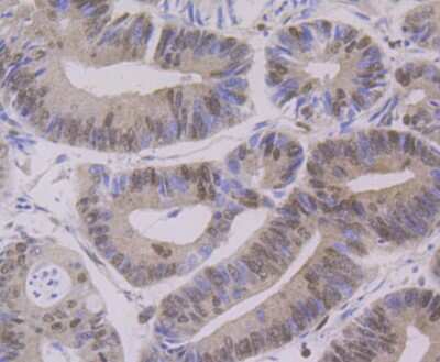Immunohistochemistry-Paraffin: PTBP1 Antibody (9A1) [NBP2-75636] - Analysis of paraffin-embedded human colon cancer tissue using anti-PTBP1 antibody. Counter stained with hematoxylin.