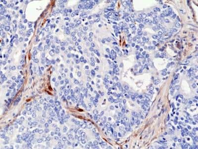 Immunohistochemistry-Paraffin: PTEN Antibody (RM265) [NBP2-77408] - Immunohistochemical staining of formalin fixed and paraffin embedded human prostate cancer sections using NBP2-77408 at a 1:2000 dilution.