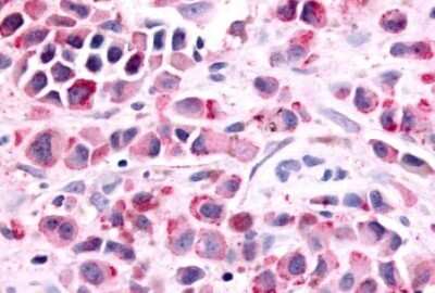 Immunohistochemistry-Paraffin: PTGER1 Antibody [NLS962] - Anti-PTGER1 / EP1 antibody IHC of human Skin, Melanoma. Immunohistochemistry of formalin-fixed, paraffin-embedded tissue after heat-induced antigen retrieval.