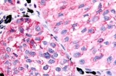 Immunohistochemistry-Paraffin: PTGER1 Antibody [NLS962] - Anti-PTGER1 / EP1 antibody IHC of human Lung, Non-Small Cell Carcinoma. Immunohistochemistry of formalin-fixed, paraffin-embedded tissue after heat-induced antigen retrieval.