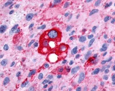 Immunohistochemistry-Paraffin: PTGFR Antibody [NLS6624] - Analysis of anti-PTGFR antibody with human brain, glioblastoma.