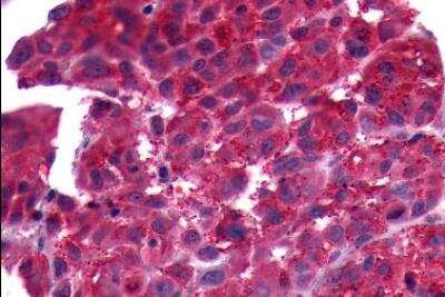 Immunohistochemistry-Paraffin: PTGFR Antibody [NLS6624] - Human Skin, Melanoma. Immunohistochemistry of formalin-fixed, paraffin-embedded tissue after heat-induced antigen retrieval.