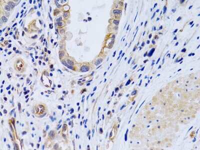 Immunohistochemistry-Paraffin: PTGIR Antibody [NBP2-93654] - Paraffin-embedded human gastric cancer using PTGIR .