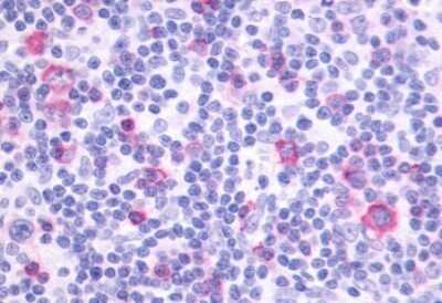 Immunohistochemistry-Paraffin: PTGIR Antibody [NLS4395] - Human Lymph Node, Hodgkins Lymphoma tissue after heat-induced antigen retrieval.