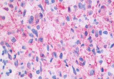 Immunohistochemistry-Paraffin: PTGIR Antibody [NLS4395] - Brain, Glioblastoma