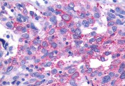 Immunohistochemistry-Paraffin: PTGIR Antibody [NLS4395] - Ovary, carcinoma
