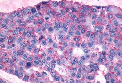 Immunohistochemistry-Paraffin: PTGIR Antibody [NLS4395] - Lung, non small cell carcinoma