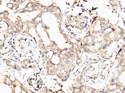 Immunohistochemistry-Paraffin: PTH1R/PTHR1 Antibody [NBP2-99962] - Immunochemical staining of human PTH1R/PTHR1 in human mammary adenocarcinoma with rabbit polyclonal antibody (1:1000, formalin-fixed paraffin embedded sections).