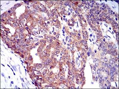 Immunohistochemistry: PTK9 Antibody (7C11) [NBP2-37456] - Immunohistochemical analysis of paraffin-embedded ovarian cancer tissues using TWF1 mouse mAb with DAB staining.