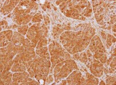 Immunohistochemistry-Paraffin: PTK9 Antibody [NBP1-33132] -  Paraffin-embedded SW480 xenograft. PTK9 antibody dilution: 1:500.