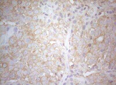 Immunohistochemistry-Paraffin: PTK9 Antibody (OTI5C12) [NBP2-46251] - Staining of paraffin-embedded Adenocarcinoma of Human breast tissue tissue using anti-TWF1 mouse monoclonal antibody. 