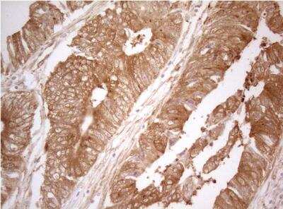 Immunohistochemistry-Paraffin: PTK9 Antibody (OTI5C12) [NBP2-46251] - Staining of paraffin-embedded Adenocarcinoma of Human colon tissue using anti-TWF1 mouse monoclonal antibody. 