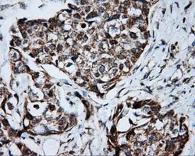 Immunohistochemistry-Paraffin: PTP epsilon Antibody (5F2) [NBP2-02374] - Staining of paraffin-embedded Adenocarcinoma of breast tissue using anti-PTP epsilon mouse monoclonal antibody.