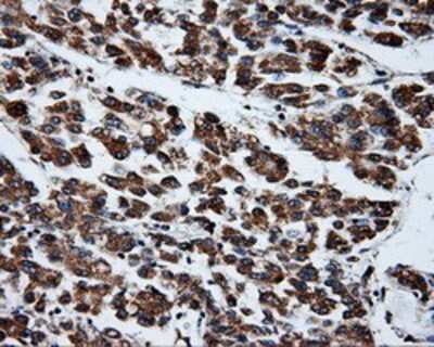 Immunohistochemistry-Paraffin: PTP epsilon Antibody (5F2) [NBP2-02374] - Staining of paraffin-embedded Carcinoma of liver tissue using anti-PTP epsilon mouse monoclonal antibody.