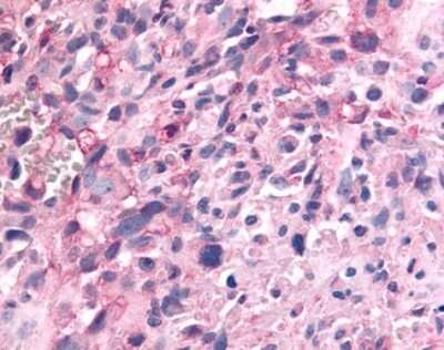 Immunohistochemistry-Paraffin: PTP epsilon Antibody [NLS6800] - Analysis of anti-PTPRE / PTP Epsilon antibody with human brain, glioblastoma.
